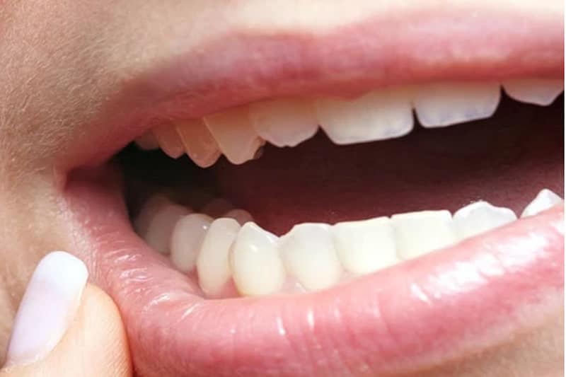 9 Common causes of painful teeth