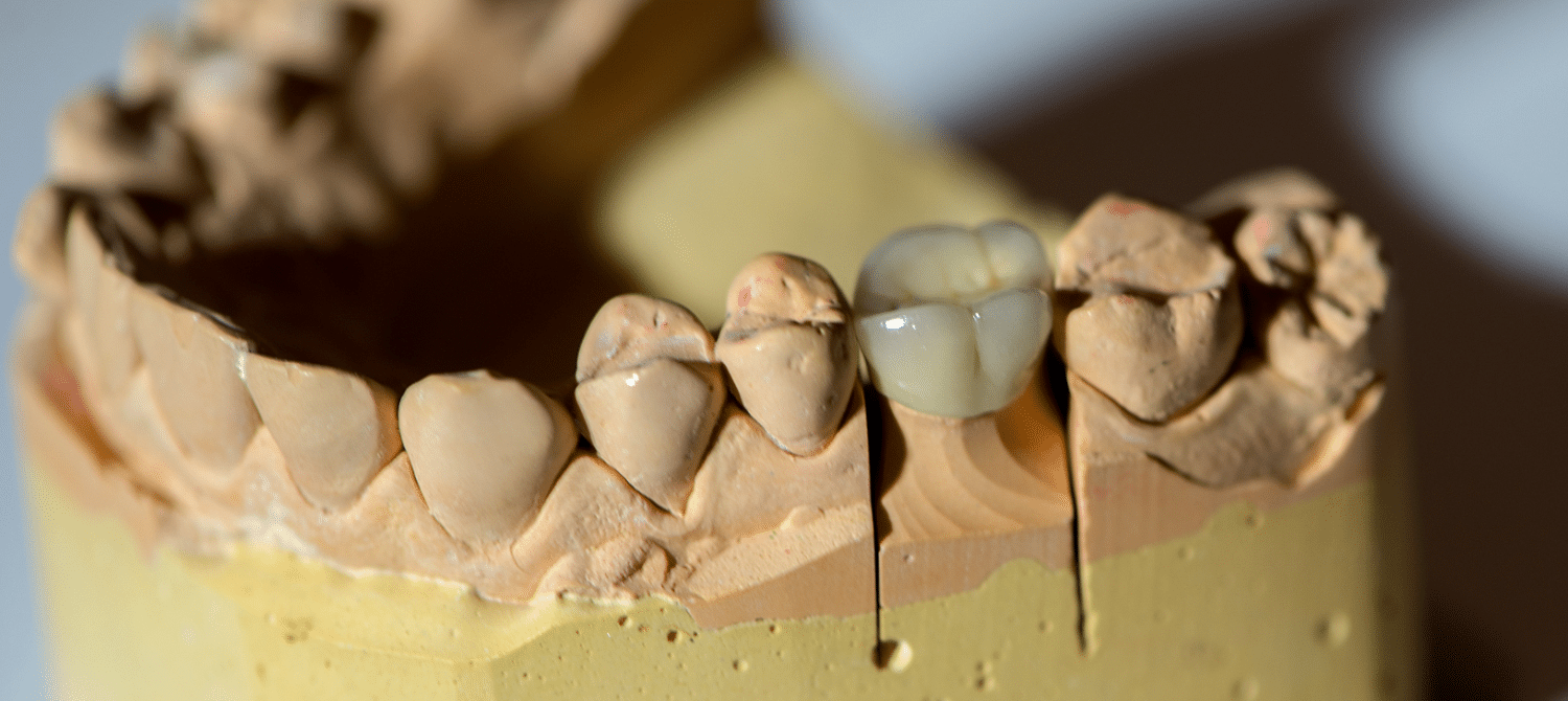 Dental Crowns in League City, Texas