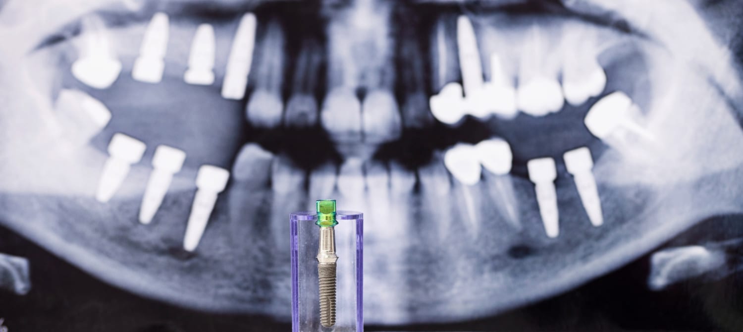 dental implants In League City, Texas