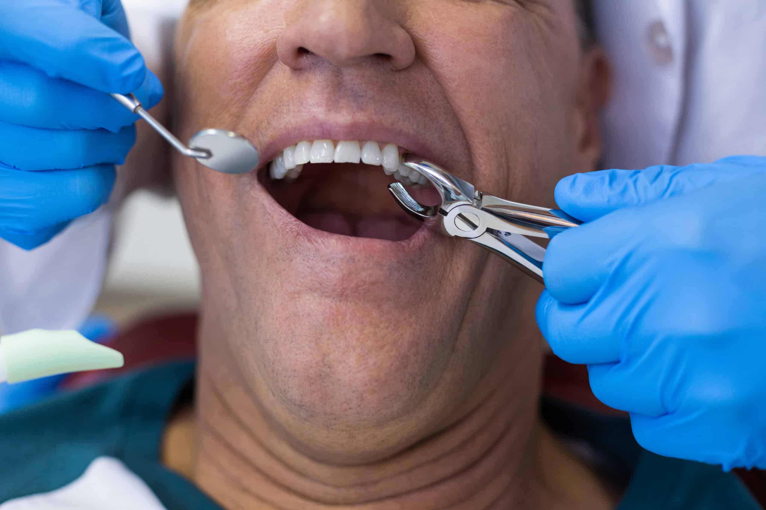 Tooth Extraction in League City, Texas