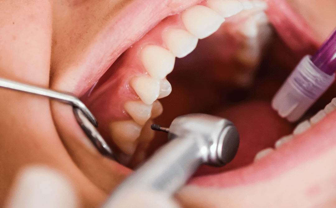 The Importance of Regular Dental Check-Ups: Catching Dental Problems Early