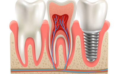 Is a Root Canal Painful? Myths vs. Facts from Your League City Dentist