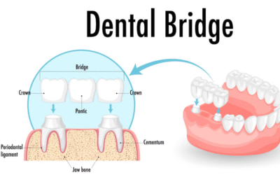 The Dental Bridge Procedure Explained Step-by-Step