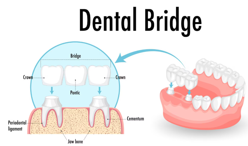 The Dental Bridge Procedure Explained Step-by-Step
