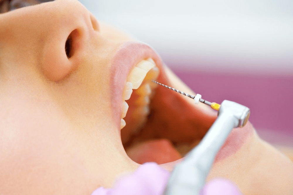 Is a Root Canal Painful? Here’s the Truth