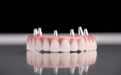 League City Dentures: What to Know About Tooth Replacement Options