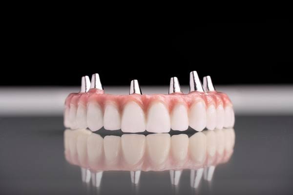 League City Dentures: What to Know About Tooth Replacement Options