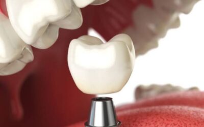When a Damaged Tooth Needs Protection: Dental Crowns in League City