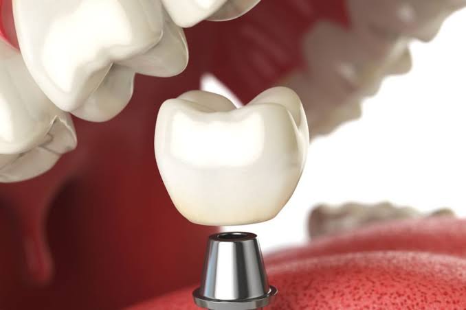 When a Damaged Tooth Needs Protection: Dental Crowns in League City