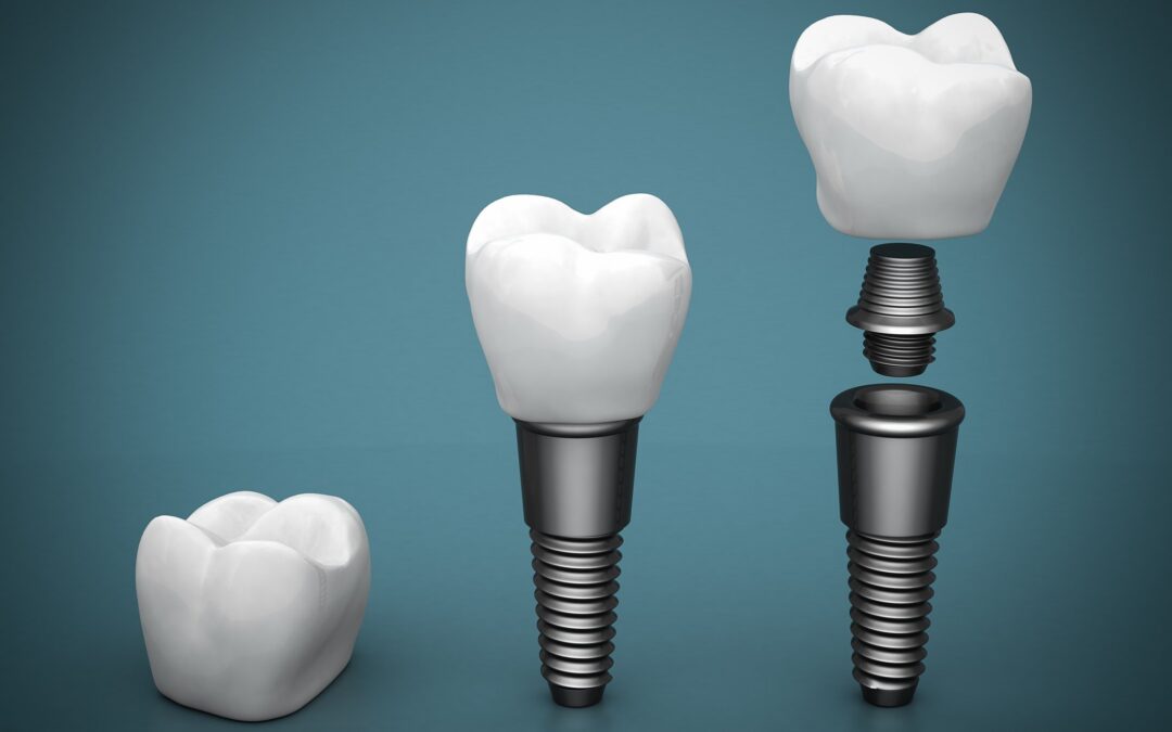 Dental Implants in League City: What Patients Should Know