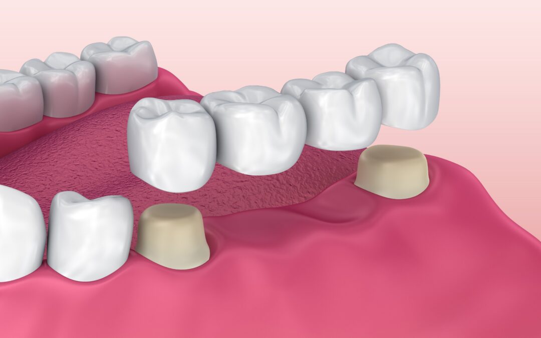 League City Dental Bridge: Things to Consider Before Getting Treated