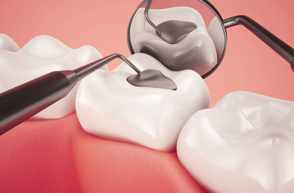 Dental Fillings in League City: Preventing Cavities and Preserving Teeth
